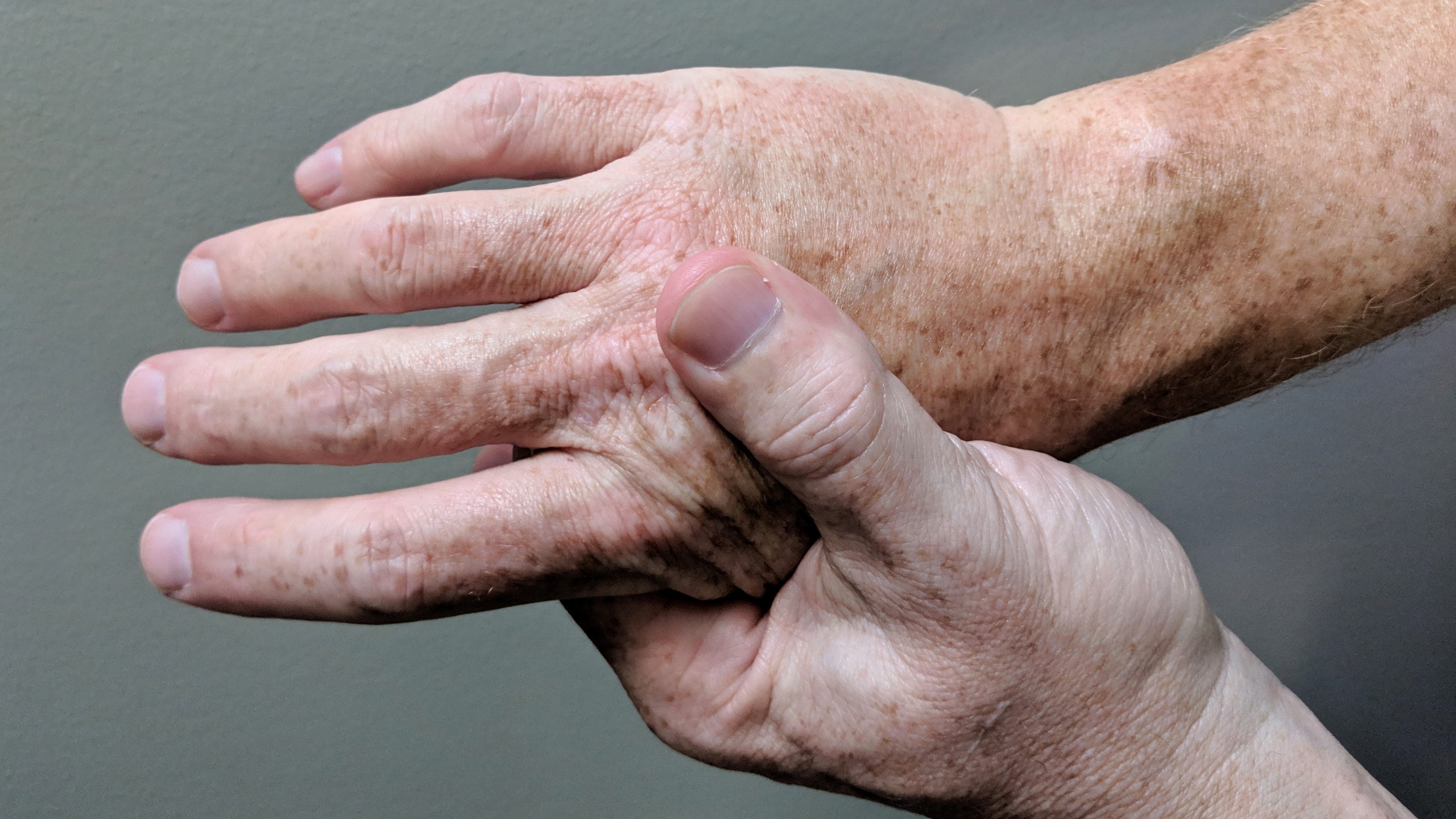 Arthritic_hands_in_pain-1