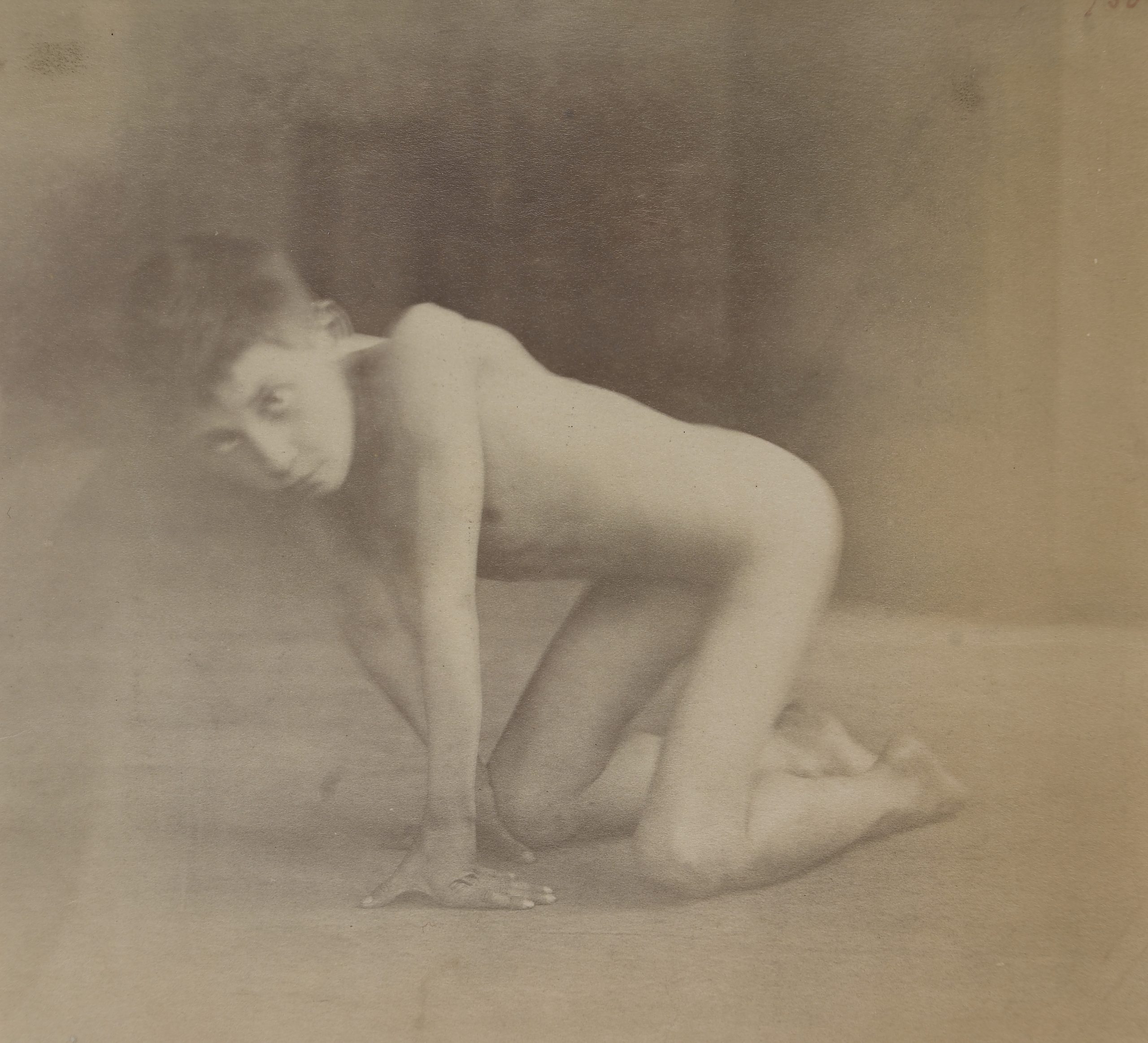 L0061479 Boy with pseudo-hypertrophic paralysis