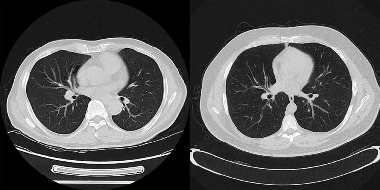 CT_scan_Iterative_reconstruction_28left29_versus_filtered_backprojection_28right29-1