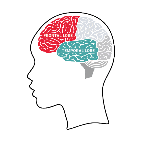FTD_Frontal_Temporal_Lobes_Labeled-1