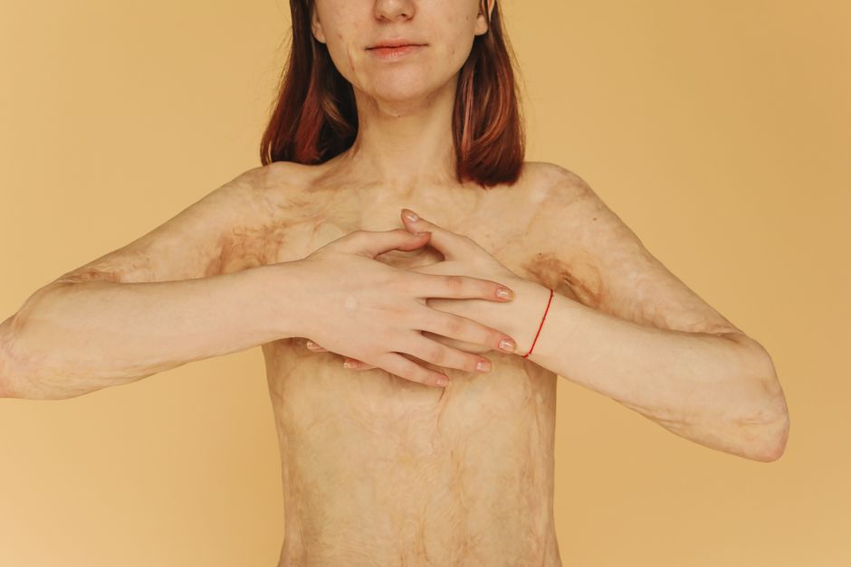Empowering close-up portrait of a woman with burn scars on a yellow background.